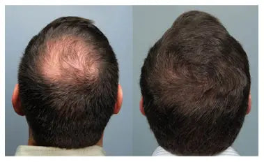 Adivasi Ayurvedic Hair Oil for Hair Growth | Control Hair loss & Dandruff | - Aryusutra Herbal